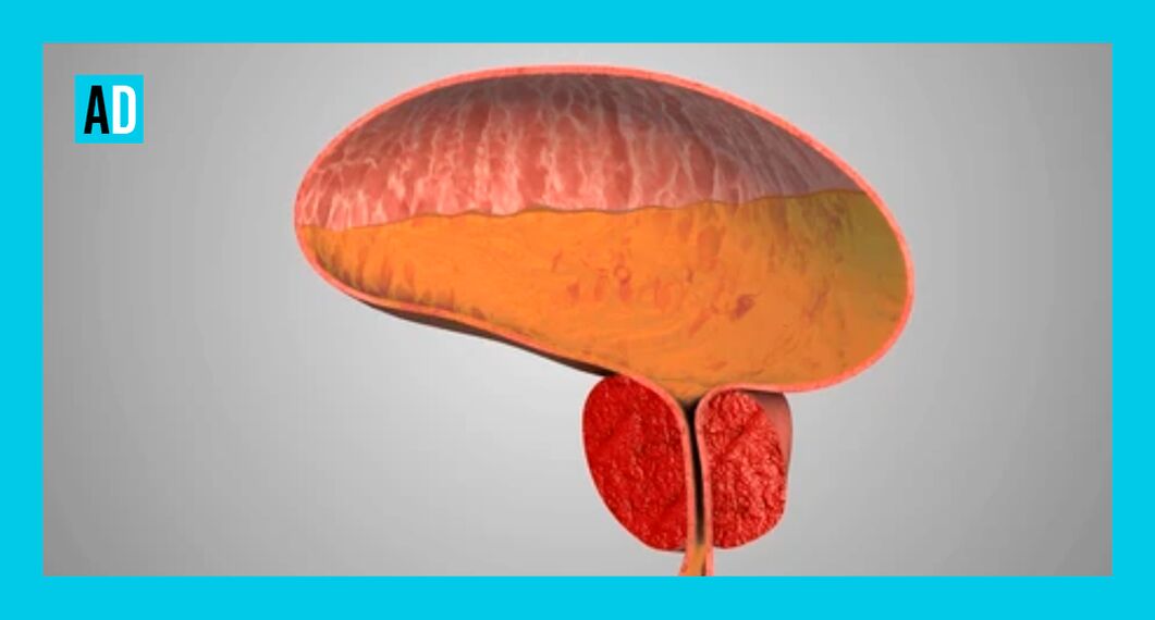 Възпалена простатна жлеза